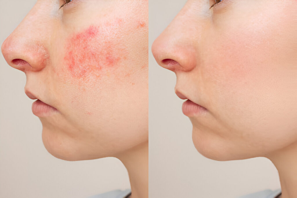 face comparison woman suffering from skin chronic disease rosacea her face acute stage 753567 222 1