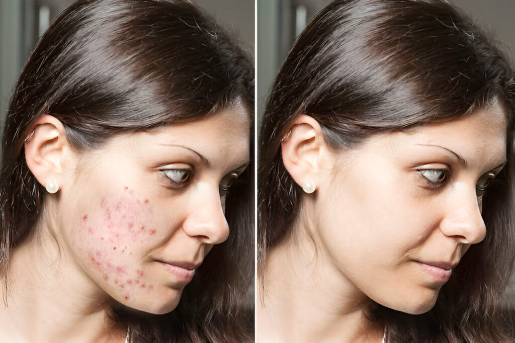 young woman with brunette hair shows before after results successful acne treatment spots scars have been removed through application prescribed topical creams 651462 824 1