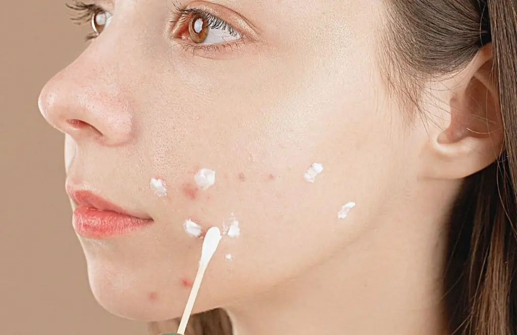 adapalene and benzoyl peroxide is a powerful solution to combat acne effectively